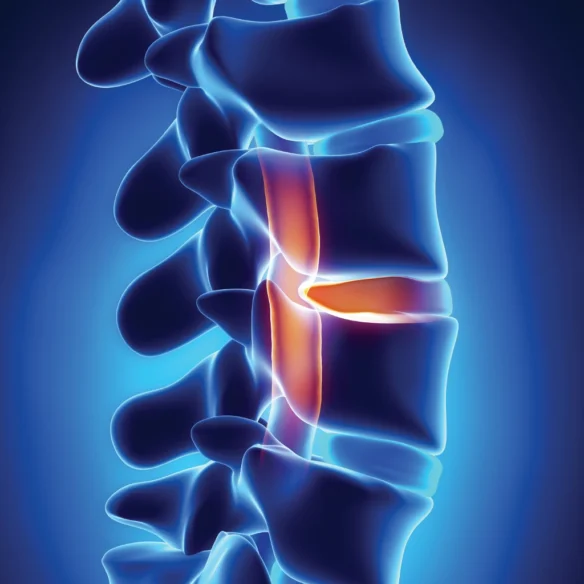 An image of herniated disc.
